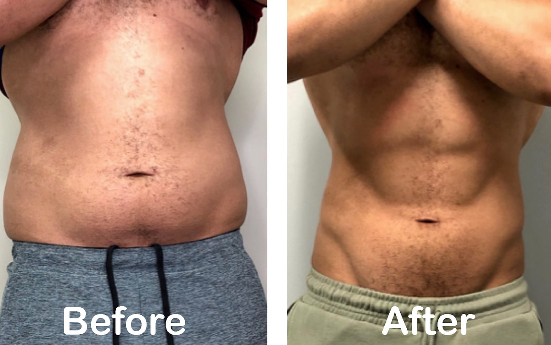 Cryoskin vs Coolsculpting, Cryoskin is better than cool sculpting, cryoskin for men