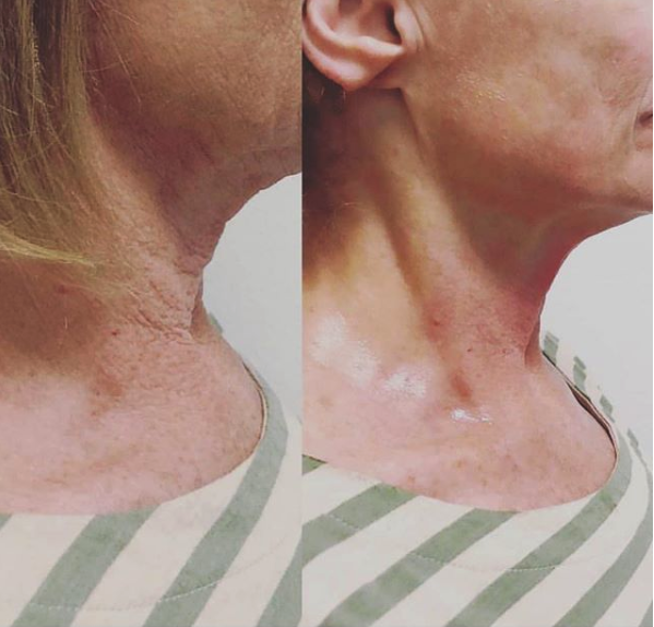 Cryoskin for double chin